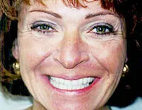 Smile Gallery before and after photos