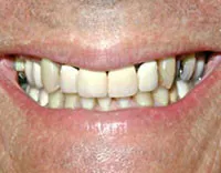 Before Single Porcelain Crown, Patient 75307