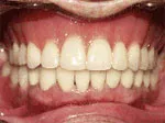 beautiful smile after dentures