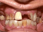 missing tooth before dentures