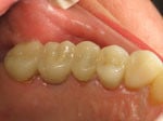 crown placed after dental implant