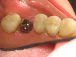 before dental implant