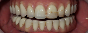 Smile Gallery before and after photos