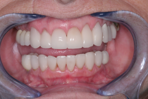 Smile Gallery before and after photos
