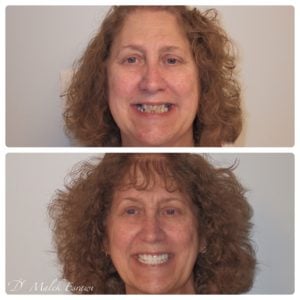 Smile Gallery before and after photo