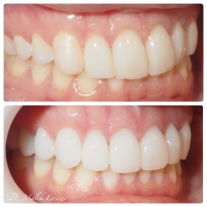 Smile Gallery before and after photo