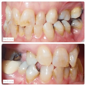 Smile Gallery before and after photo