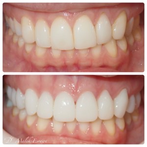 Smile Gallery before and after photo