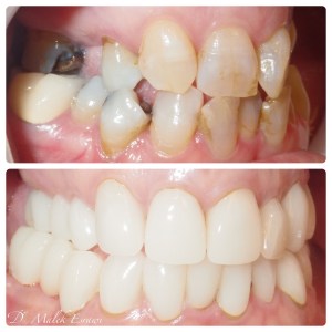 Smile Gallery before and after photo