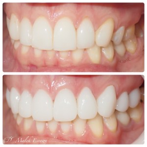 Smile Gallery before and after photo