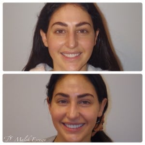 Smile Gallery before and after photo