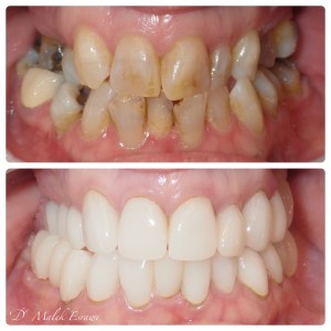 Smile Gallery before and after photo