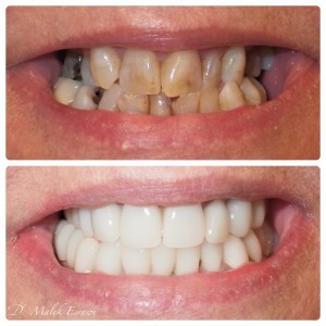 Smile Gallery before and after photo