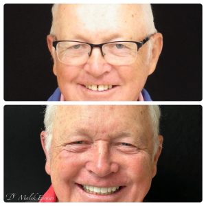 Smile Gallery before and after photo