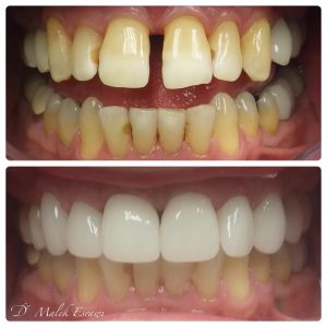 Smile Gallery before and after photo