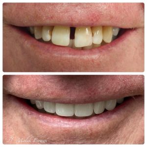Smile Gallery before and after photo