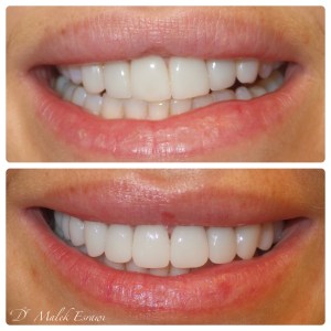 Smile Gallery before and after photo