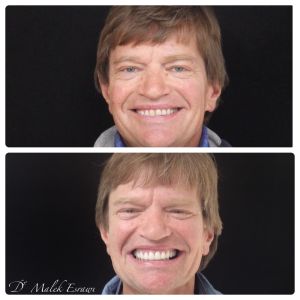 Smile Gallery before and after photo