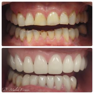 Smile Gallery before and after photo