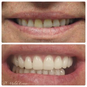 Smile Gallery before and after photo