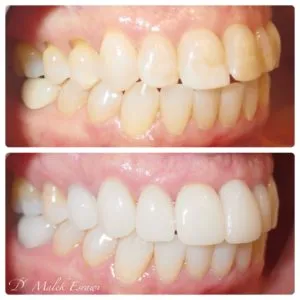 Smile Gallery before and after photo