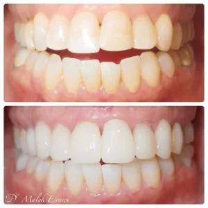 Smile Gallery before and after photo