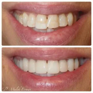 Smile Gallery before and after photo