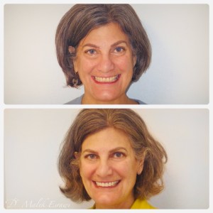 Smile Gallery before and after photo