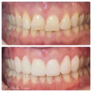 Smile Gallery before and after photo