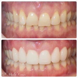Smile Gallery before and after photo