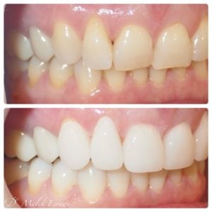 Smile Gallery before and after photo