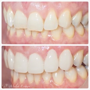 Smile Gallery before and after photo