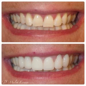 Smile Gallery before and after photo